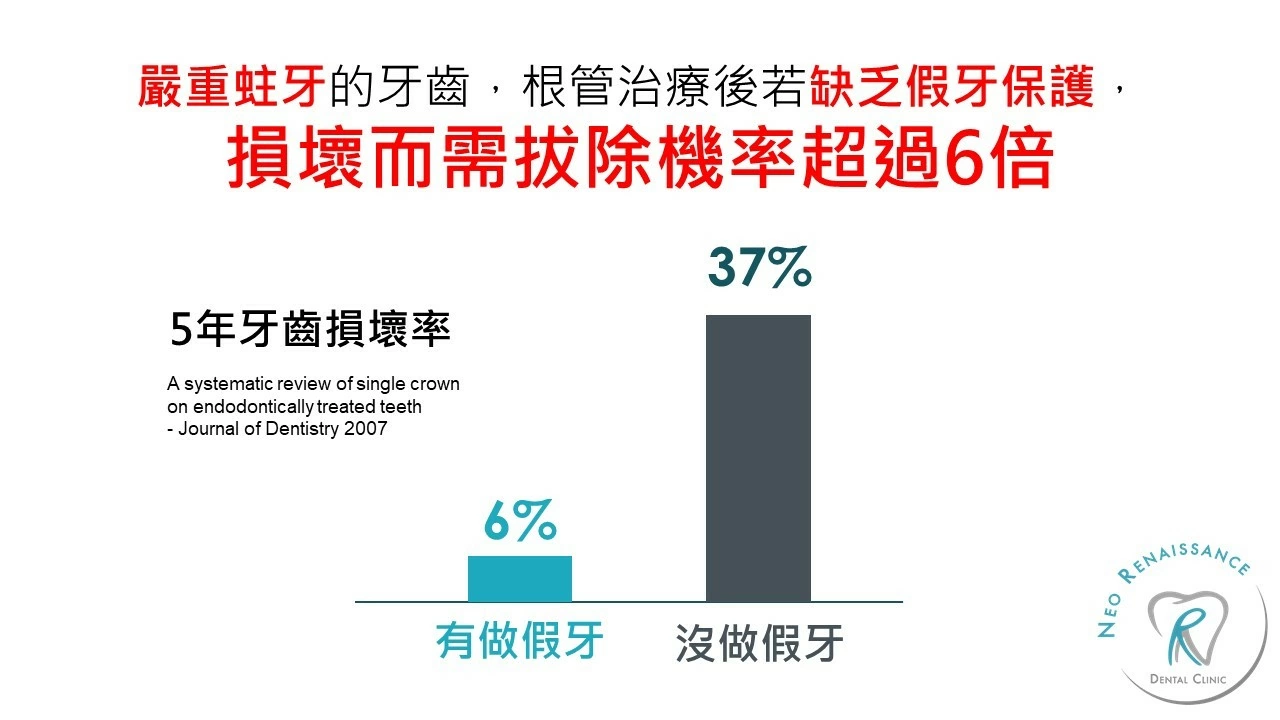 根管治療 根管治療